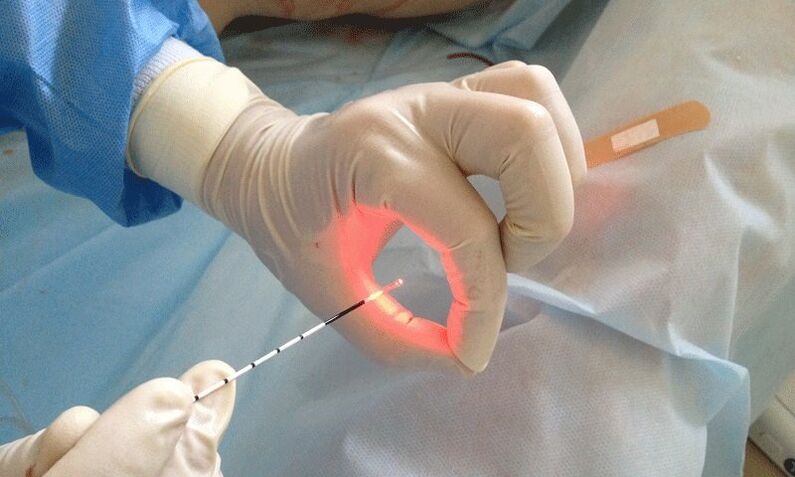 laser treatment of prostatitis